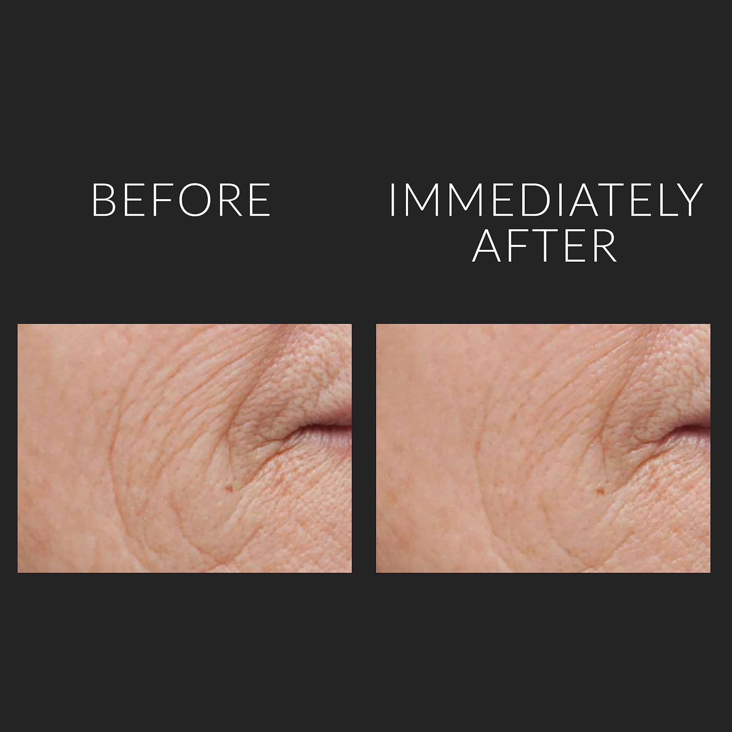 KATE SOMERVILLE DermalQuench® Hyaluronic Acid Hydration Treatment купить в Beauty Storage. Быстрая доставка по России и СНГ.