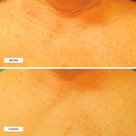 PERRICONE MD Cold Plasma Plus+ Neck & Chest Broad Spectrum SPF 25