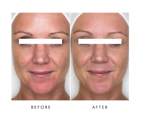 ALPHA-H Beauty Sleep Power Peel