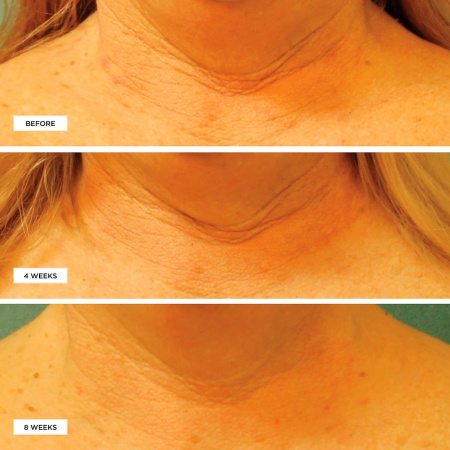 PERRICONE MD Cold Plasma Plus+ Neck & Chest Broad Spectrum SPF 25