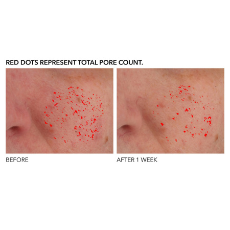 DR. DENNIS GROSS SKINCARE Alpha Beta® Pore Perfecting & Refining Serum