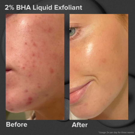 PAULA'S CHOICE Multi-Level Exfoliation Kit купить в Beauty Storage. Быстрая доставка по России и СНГ.
