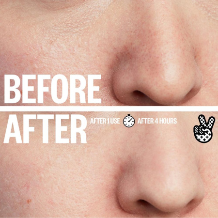 PEACE OUT Pore Treatment Strips