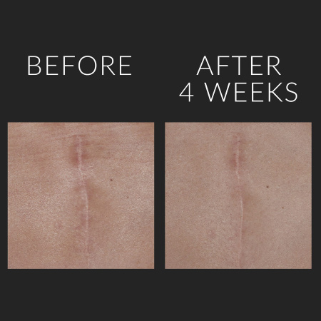 KATE SOMERVILLE D-Scar™ Scar Diminishing Serum